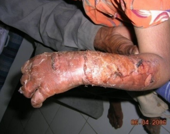 Burned arm by hot milk