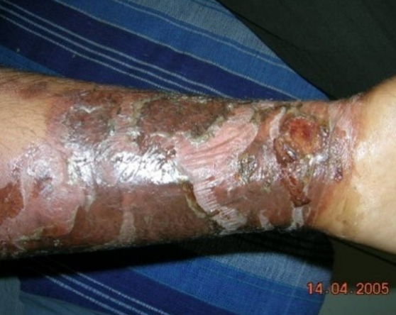 Burned arm by steam car radiator