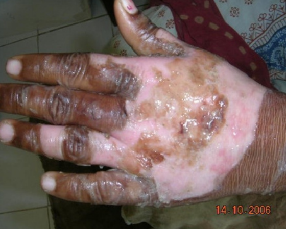 Burned hand by hot oil